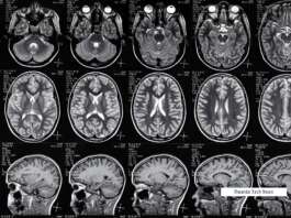 Brain-Machine Interfaces